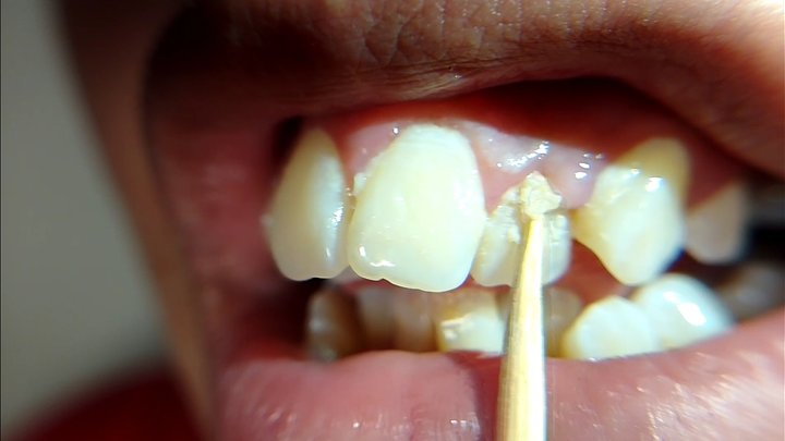 Cleaning my teeth with a wooden toothpick after 15 days without brushing (full v