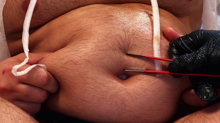 Clinical Insertion: Deep Bellybutton Exam