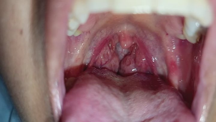 Amígdalas grandes: abro mi boca y muestro el interior de cerca