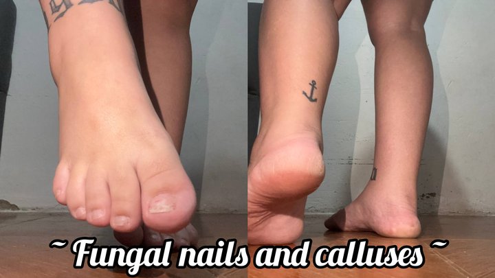 Fungal nails and calloused heels