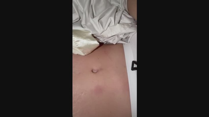 Screw buried deep in bellybutton