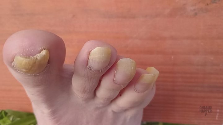 Gnarlie Harper Toenail Growth Update - 6 Months No Cut - My US 11 Bad Yellow Nai