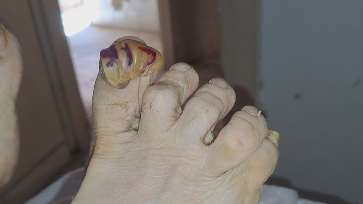TOENAIL SEVERE INFECTION
