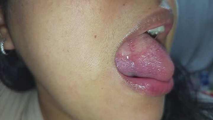 Mordidas en mi lengua y las marcas que quedan