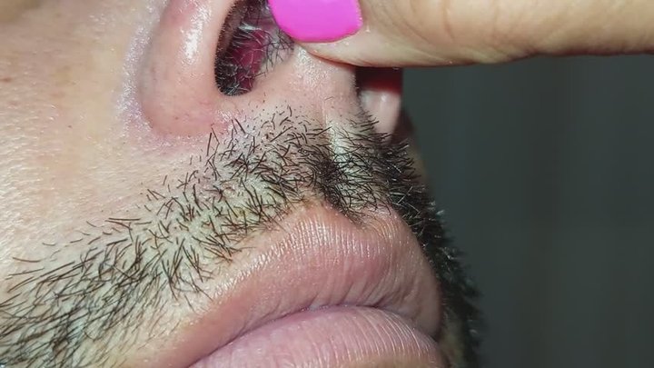 Una nariz hermosa en primer plano y algunas pinzas